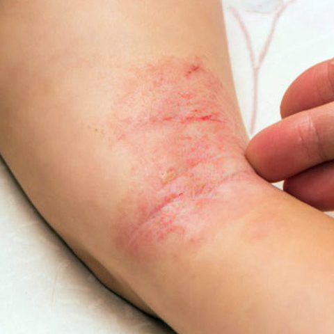 Exemplo clínico de dermatite atópica