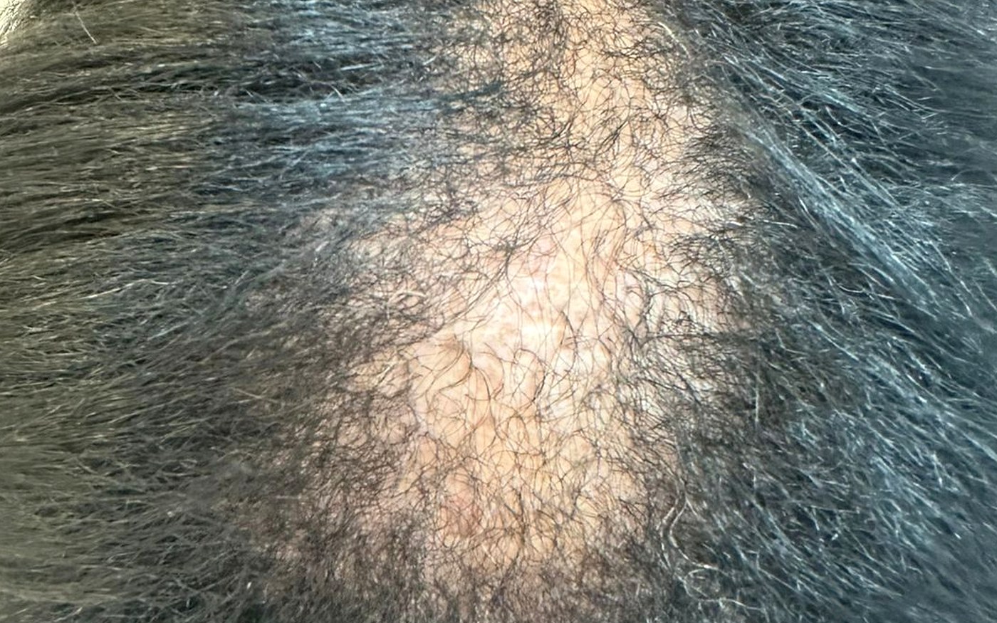 Exemplo clínico de alopecias e queda de cabelo