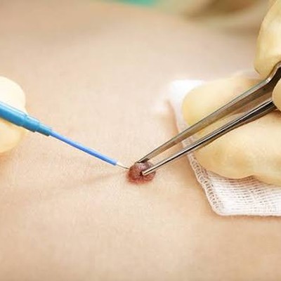 Exemplo clínico de cirurgia dermatológica
