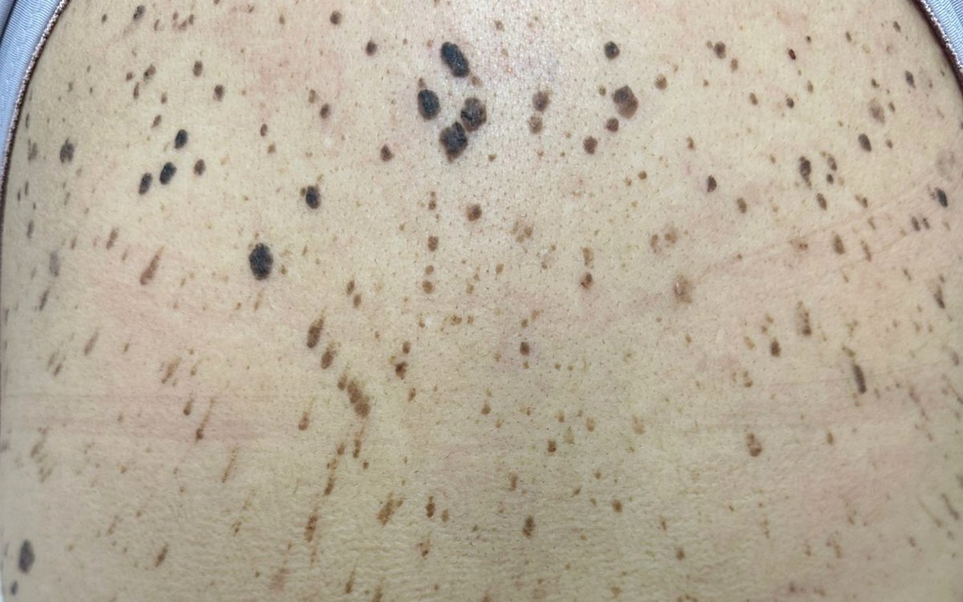 Dorso com múltiplas queratoses seborreicas e lesões pigmentadas avaliadas em mapeamento corporal, em imagem clínica ilustrativa