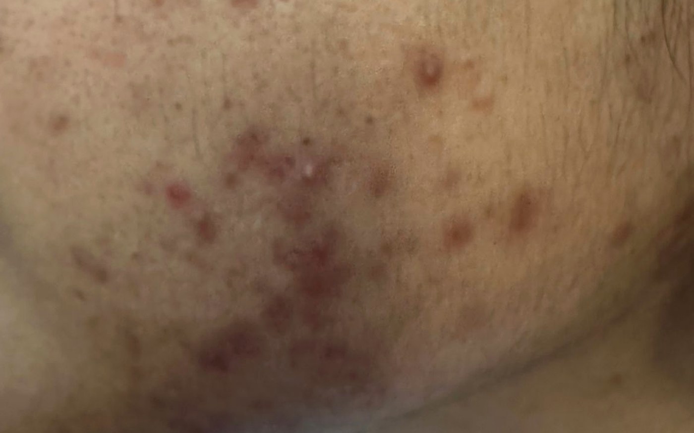 Lesões inflamatórias de acne na região da face, em imagem clínica ilustrativa
