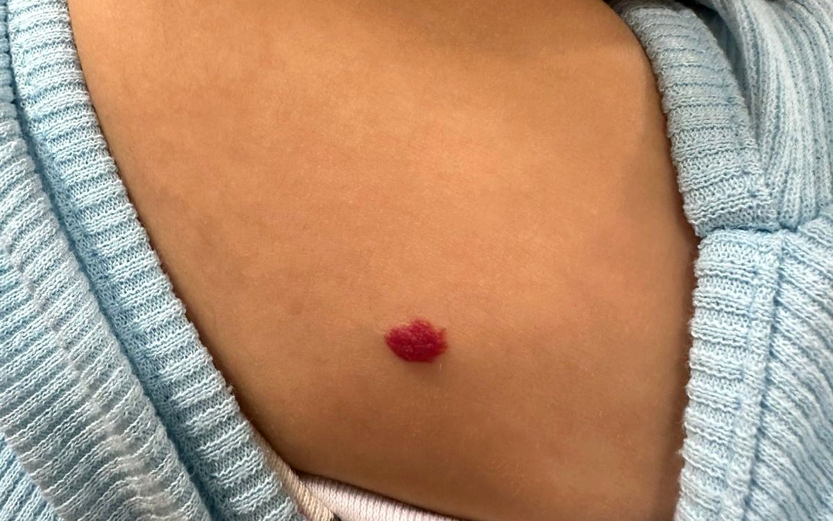 Hemangioma infantil em ombro de lactente, em imagem clínica ilustrativa publicada com autorização