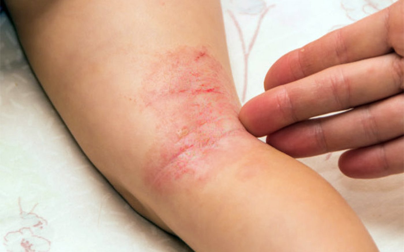 Lesões avermelhadas e descamativas de dermatite atópica na dobra do braço de uma criança, em imagem clínica ilustrativa
