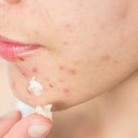 Exemplo clínico de acne e isotretinoína