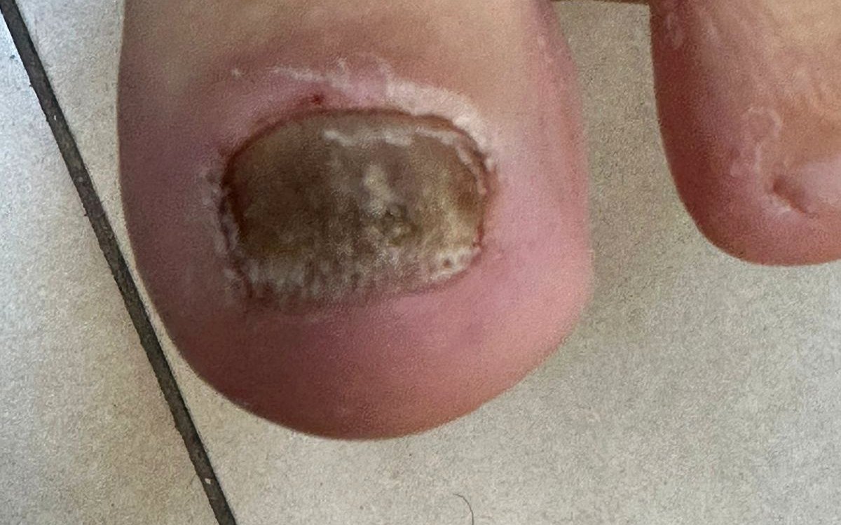 Onicomicose: unha do pé espessada e descolorida por infecção fúngica, em imagem clínica ilustrativa publicada com autorização