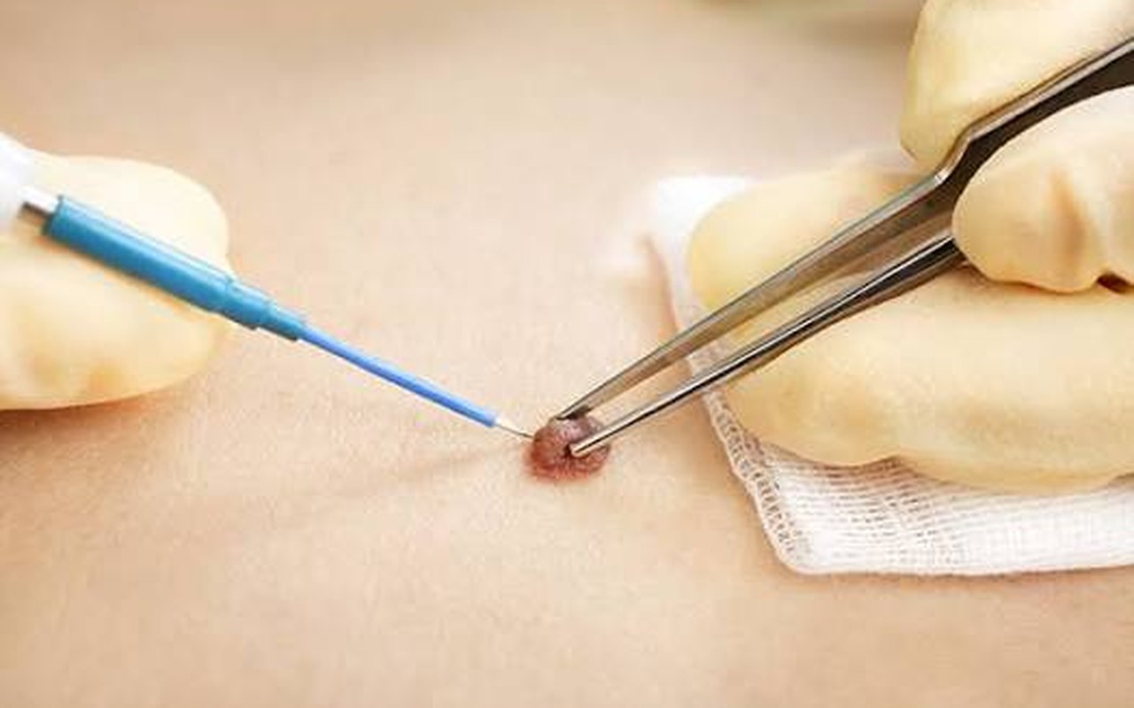 Procedimento de cirurgia dermatológica em consultório: retirada de lesão de pele com bisturi elétrico e pinça, em imagem ilustrativa