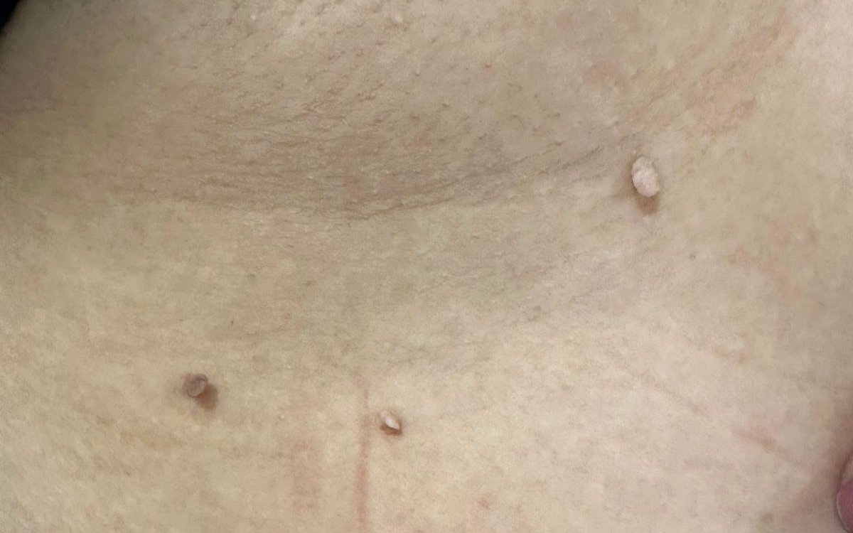 Acrocórdons (fibromas moles) no pescoço, lesões benignas removidas em consultório, em imagem clínica ilustrativa publicada com autorização