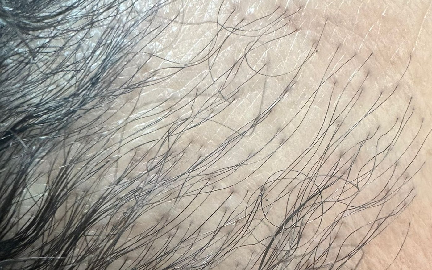 Recuo da linha frontal de implantação dos cabelos, com fios isolados, em imagem clínica ilustrativa de alopecia frontal fibrosante