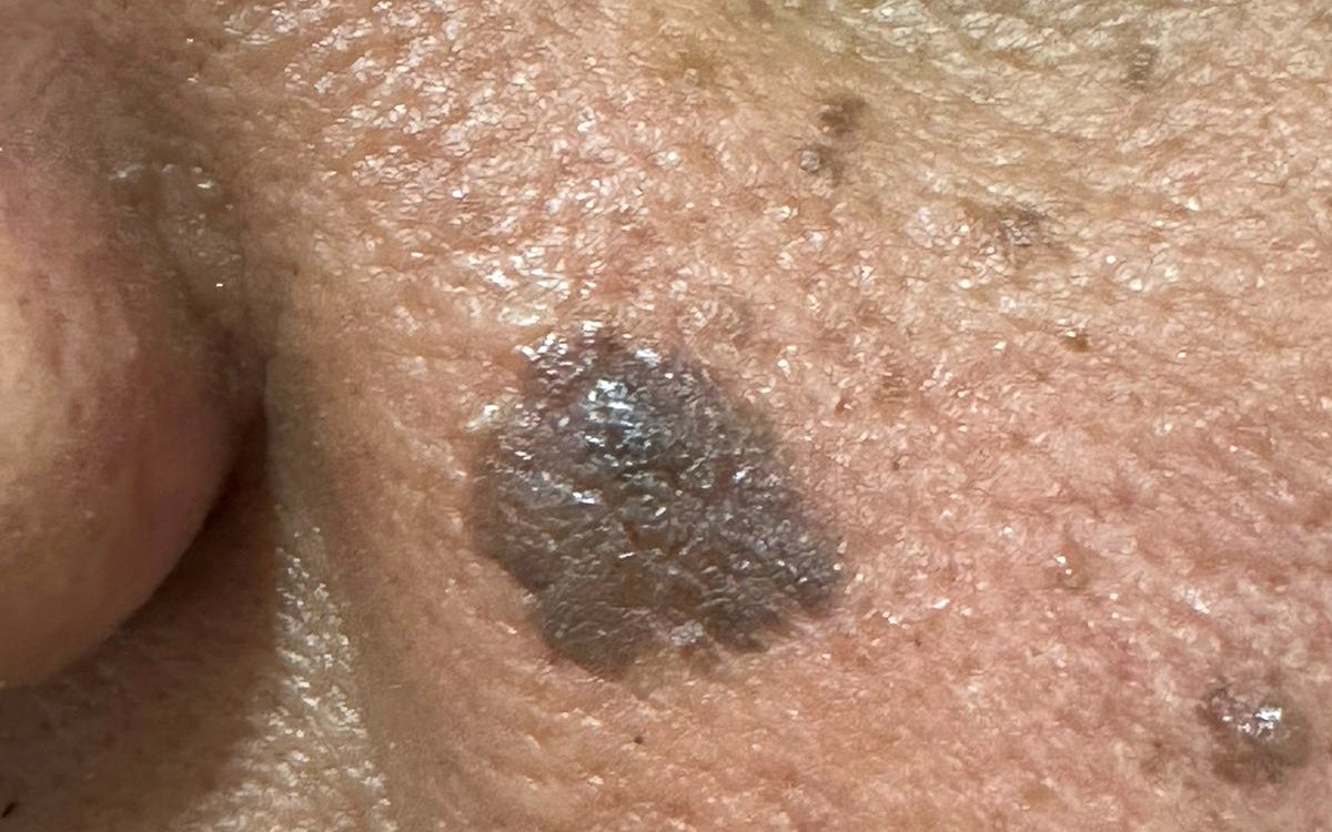 Queratose seborreica na face, lesão benigna acastanhada avaliada com dermatoscopia, em imagem clínica ilustrativa publicada com autorização