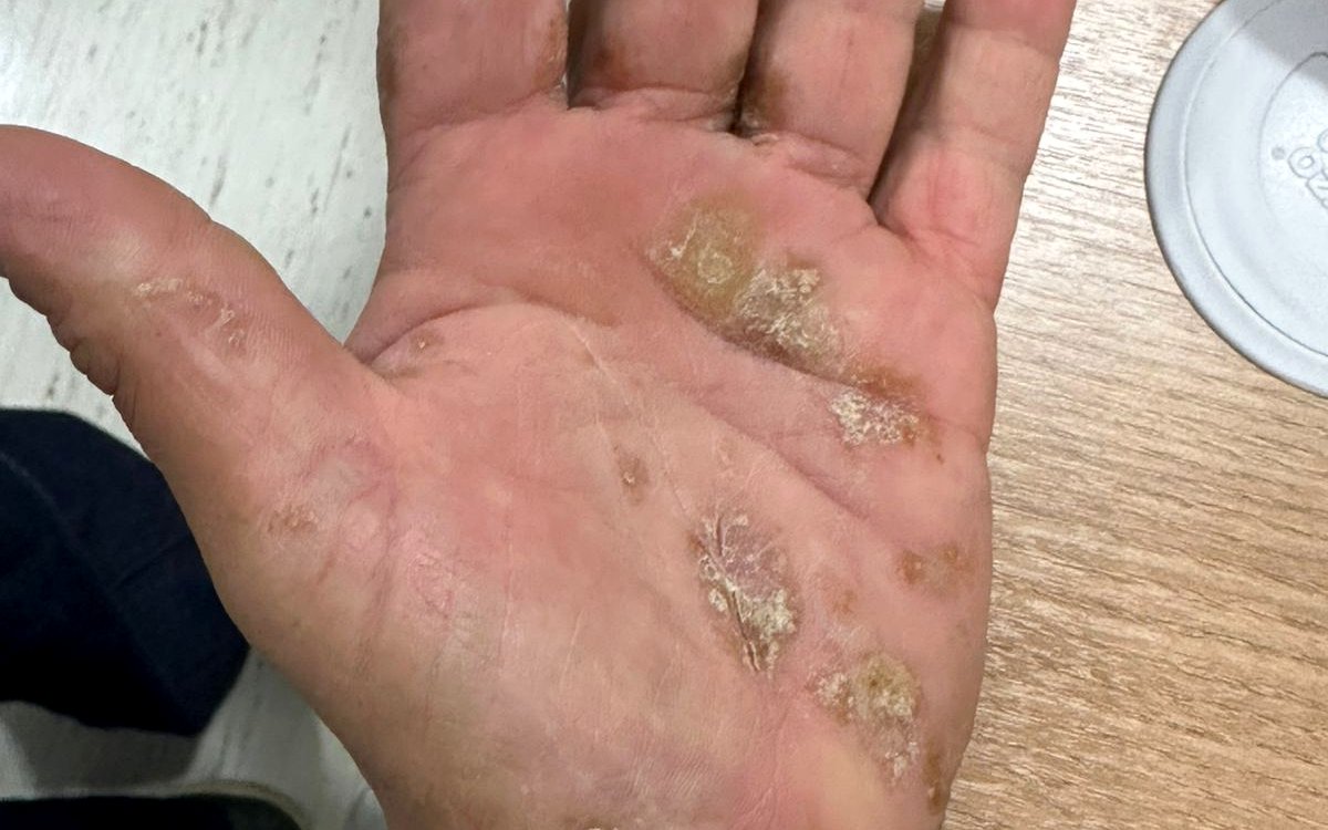 Psoríase palmoplantar com placas descamativas na palma da mão, em imagem clínica ilustrativa publicada com autorização