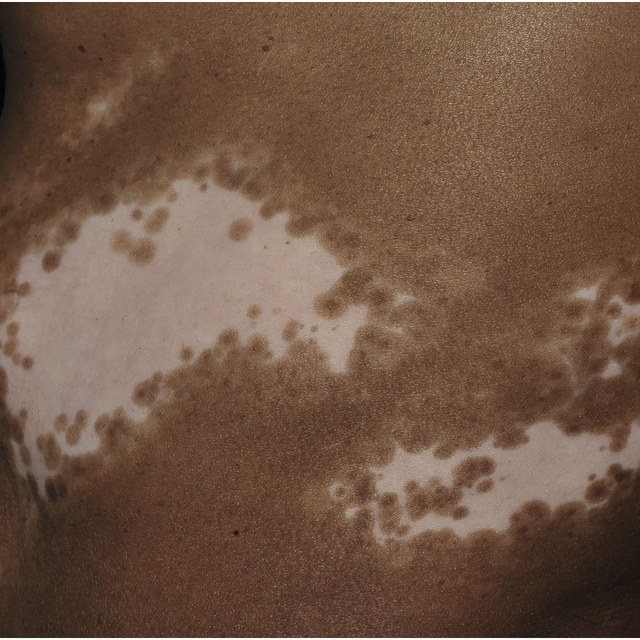 Exemplo clínico de vitiligo