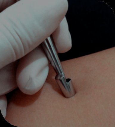 Realização de biópsia de pele com punch em consultório dermatológico, em imagem ilustrativa