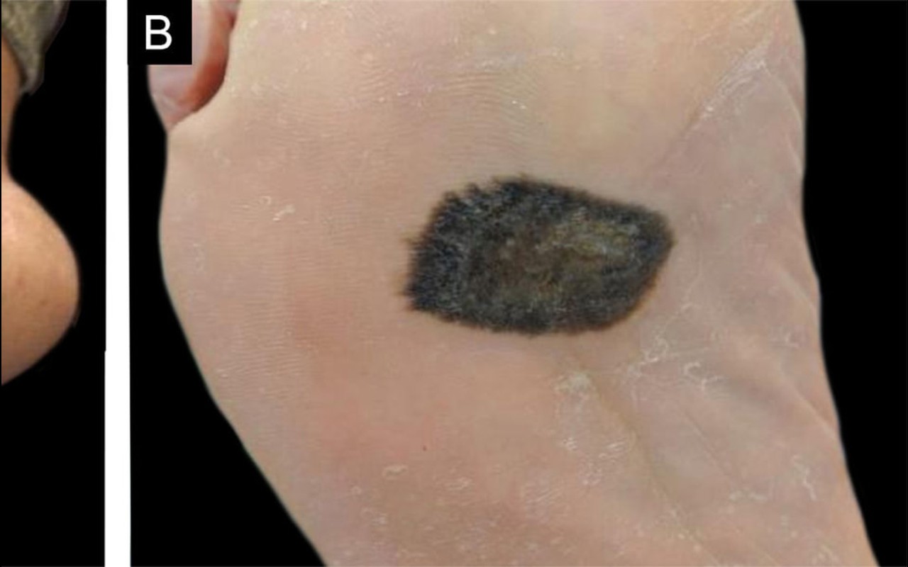 Melanoma acral em região plantar, com lesão pigmentada irregular, em imagem clínica ilustrativa publicada com autorização